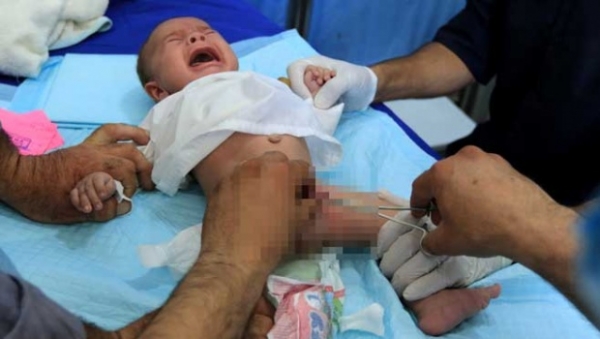 Sunat 123 - 4 Alasan Mengapa Sunat Konvensional Masih Jadi Pilihan