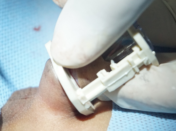 Sunat 123 - Keunggulan dan Risiko Sunat Klamp untuk Anak